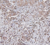 IHC staining of FFPE human breast cancer with HLA-DRA antibody. HIER: boil tissue sections in pH6, 10mM citrate buffer, for 20 min and allow to cool before testing.