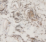 IHC staining of FFPE human breast cancer with HLA-DRA antibody. HIER: boil tissue sections in pH6, 10mM citrate buffer, for 20 min and allow to cool before testing.