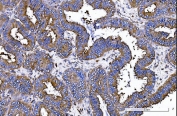 IHC staining of FFPE human endometrial adenocarcinoma with IQGAP1 antibody. HIER: boil tissue sections in pH8 EDTA for 20 min and allow to cool before testing.