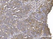 IHC staining of FFPE human ovarian cancer with IQGAP1 antibody. HIER: boil tissue sections in pH8 EDTA for 20 min and allow to cool before testing.