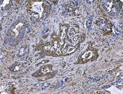 IHC staining of FFPE human gallbladder squamous cell carcinoma with IQGAP1 antibody. HIER: boil tissue sections in pH8 EDTA for 20 min and allow to cool before testing.