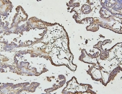 IHC staining of FFPE human ovarian cancer with IRAK1 antibody. HIER: boil tissue sections in pH6, 10mM citrate buffer, for 20 min and allow to cool before testing.