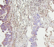 IHC staining of FFPE human ovarian cancer with IRAK1 antibody. HIER: boil tissue sections in pH6, 10mM citrate buffer, for 20 min and allow to cool before testing.