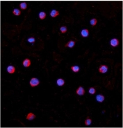 Immunofluorescent staining of FFPE human K562 cells with IRAK1 antibody (red) and DAPI nuclear stain (blue). HIER: steam section in pH6 citrate buffer for 20 min.