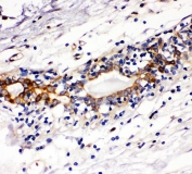 IHC staining of FFPE human breast cancer with c-Kit antibody. HIER: boil tissue sections in pH6, 10mM citrate buffer, for 20 min and allow to cool before testing.