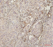 IHC staining of FFPE human lung cancer with LPP antibody. HIER: boil tissue sections in pH6, 10mM citrate buffer, for 20 min and allow to cool before testing.