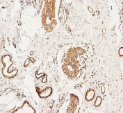 IHC staining of FFPE human breast cancer with LPP antibody. HIER: boil tissue sections in pH6, 10mM citrate buffer, for 20 min and allow to cool before testing.