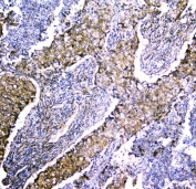 IHC staining of FFPE human lung cancer with LRTOMT antibody. HIER: boil tissue sections in pH6, 10mM citrate buffer, for 20 min and allow to cool before testing.
