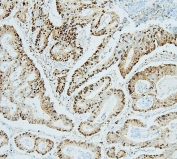 IHC staining of FFPE human intestinal cancer with MCM2 antibody. HIER: boil tissue sections in pH6, 10mM citrate buffer, for 20 min and allow to cool before testing.