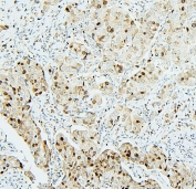 IHC staining of FFPE human breast cancer with MCM2 antibody. HIER: boil tissue sections in pH6, 10mM citrate buffer, for 20 min and allow to cool before testing.