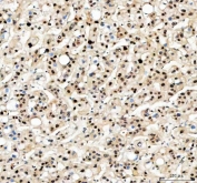 IHC staining of FFPE human liver cancer tissue with PCNA antibody. HIER: boil tissue sections in pH8 EDTA for 20 min and allow to cool before testing.