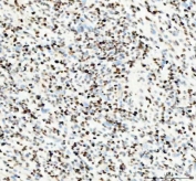 IHC staining of FFPE human glioblastoma tissue with PCNA antibody. HIER: boil tissue sections in pH8 EDTA for 20 min and allow to cool before testing.
