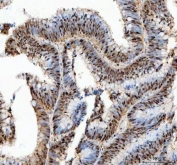IHC staining of FFPE human colorectal adenocarcinoma tissue with PCNA antibody. HIER: boil tissue sections in pH8 EDTA for 20 min and allow to cool before testing.