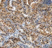 IHC staining of FFPE human papillary thyroid carcinoma tissue with PCNA antibody. HIER: boil tissue sections in pH8 EDTA for 20 min and allow to cool before testing.