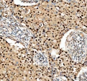 IHC staining of FFPE human breast cancer tissue with PCNA antibody. HIER: boil tissue sections in pH8 EDTA for 20 min and allow to cool before testing.