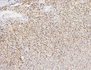 IHC staining of FFPE human renal cancer with Polycystin 2 antibody. HIER: boil tissue sections in pH6, 10mM citrate buffer, for 20 min and allow to cool before testing.