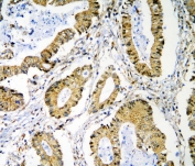 IHC staining of FFPE human rectal cancer with PRMT1 antibody. HIER: boil tissue sections in pH6, 10mM citrate buffer, for 20 min and allow to cool before testing.