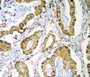 IHC staining of FFPE human rectal cancer with PRMT1 antibody. HIER: boil tissue sections in pH6, 10mM citrate buffer, for 20 min and allow to cool before testing.