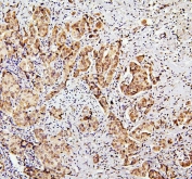 IHC staining of FFPE human breast cancer with SUZ12 antibody. HIER: boil tissue sections in pH6, 10mM citrate buffer, for 20 min and allow to cool before testing.