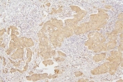 IHC staining of FFPE human breast cancer with Tafazzin antibody. HIER: boil tissue sections in pH6, 10mM citrate buffer, for 20 min and allow to cool before testing.