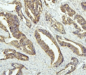 IHC staining of FFPE human colon cancer with Tafazzin antibody. HIER: boil tissue sections in pH6, 10mM citrate buffer, for 20 min and allow to cool before testing.