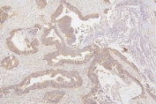 IHC staining of FFPE human colon cancer with Tafazzin antibody. HIER: boil tissue sections in pH6, 10mM citrate buffer, for 20 min and allow to cool before testing.