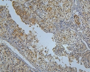 IHC staining of FFPE human liver cancer with PCSK9 antibody. HIER: boil tissue sections in pH8 EDTA for 20 min and allow to cool before testing.