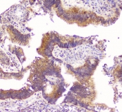 IHC staining of FFPE human rectal cancer with TNFRSF11B antibody. HIER: boil tissue sections in pH6, 10mM citrate buffer, for 20 min and allow to cool before testing.