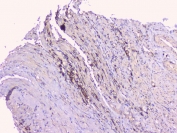 IHC staining of FFPE human endometrial carcinoma with TNFRSF11B antibody. HIER: boil tissue sections in pH6, 10mM citrate buffer, for 20 min and allow to cool before testing.