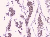 IHC staining of FFPE human glioma with TNFRSF11B antibody. HIER: boil tissue sections in pH6, 10mM citrate buffer, for 20 min and allow to cool before testing.