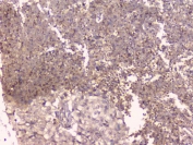 IHC staining of FFPE human lung cancer with TNFRSF11B antibody. HIER: boil tissue sections in pH6, 10mM citrate buffer, for 20 min and allow to cool before testing.