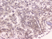 IHC staining of FFPE human liver cancer with TNFRSF11B antibody. HIER: boil tissue sections in pH6, 10mM citrate buffer, for 20 min and allow to cool before testing.