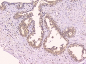 IHC staining of FFPE human breast cancer with TNFRSF11B antibody. HIER: boil tissue sections in pH6, 10mM citrate buffer, for 20 min and allow to cool before testing.