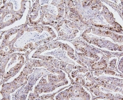 IHC staining of FFPE human rectal cancer with TOP2A antibody. HIER: boil tissue sections in pH6, 10mM citrate buffer, for 20 min and allow to cool before testing.