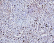 IHC staining of FFPE human lung cancer with TOP2A antibody. HIER: boil tissue sections in pH6, 10mM citrate buffer, for 20 min and allow to cool before testing.