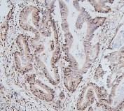 IHC staining of FFPE human colon cancer with UBC9 antibody. HIER: boil tissue sections in pH6, 10mM citrate buffer, for 20 min and allow to cool before testing.