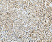 IHC staining of FFPE human pancreatic cancer with MTR antibody. HIER: boil tissue sections in pH6, 10mM citrate buffer, for 20 min and allow to cool before testing.