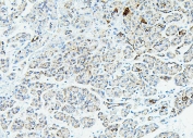 IHC staining of FFPE human pancreatic cancer with RPL13A antibody. HIER: boil tissue sections in pH6, 10mM citrate buffer, for 20 min and allow to cool before testing.