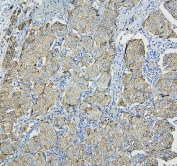 IHC staining of FFPE human breast cancer with RPL13A antibody. HIER: boil tissue sections in pH6, 10mM citrate buffer, for 20 min and allow to cool before testing.