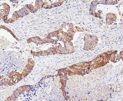 IHC staining of FFPE human colon cancer with SKP1 antibody. HIER: boil tissue sections in pH6, 10mM citrate buffer, for 20 min and allow to cool before testing.