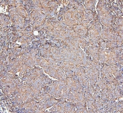 IHC staining of FFPE human breast cancer with MVP antibody. HIER: boil tissue sections in pH6, 10mM citrate buffer, for 20 min and allow to cool before testing.