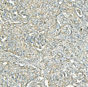 IHC staining of FFPE human lung cancer with MVP antibody. HIER: boil tissue sections in pH6, 10mM citrate buffer, for 20 min and allow to cool before testing.