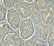 IHC staining of FFPE human colon cancer with MVP antibody. HIER: boil tissue sections in pH6, 10mM citrate buffer, for 20 min and allow to cool before testing.