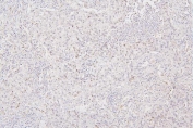IHC staining of FFPE human lung cancer with Histone H1.0 antibody. HIER: boil tissue sections in pH6, 10mM citrate buffer, for 20 min and allow to cool before testing.