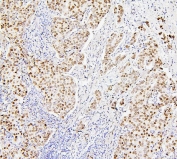 IHC staining of FFPE human breast cancer with Histone H1.0 antibody. HIER: boil tissue sections in pH6, 10mM citrate buffer, for 20 min and allow to cool before testing.