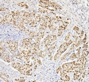 IHC staining of FFPE human breast cancer with Histone H1.0 antibody. HIER: boil tissue sections in pH6, 10mM citrate buffer, for 20 min and allow to cool before testing.