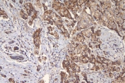IHC staining of FFPE human breast cancer with mtTFA antibody. HIER: boil tissue sections in pH6, 10mM citrate buffer, for 20 min and allow to cool before testing.