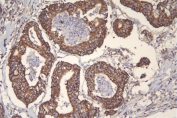 IHC staining of FFPE human rectal cancer with mtTFA antibody. HIER: boil tissue sections in pH6, 10mM citrate buffer, for 20 min and allow to cool before testing.