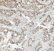 IHC staining of FFPE human liver cancer tissue with DHX15 antibody. HIER: boil tissue sections in pH8 EDTA for 20 min and allow to cool before testing.