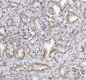 IHC staining of FFPE human prostate cancer tissue with DHX15 antibody. HIER: boil tissue sections in pH8 EDTA for 20 min and allow to cool before testing.
